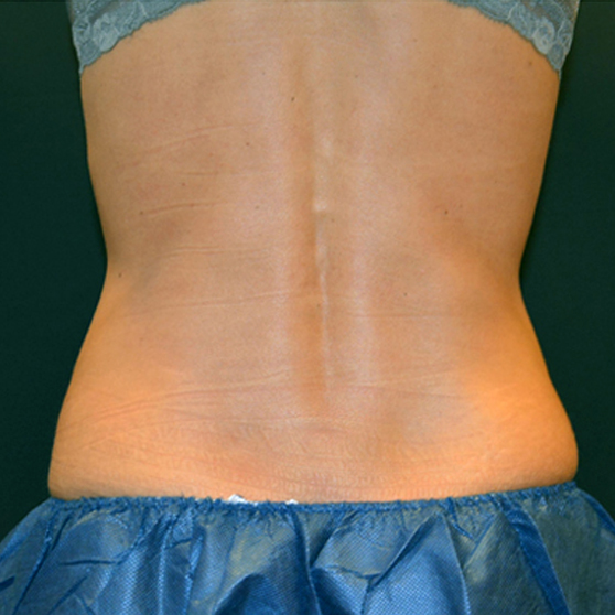 CoolSculpting for Women Before and After Photo