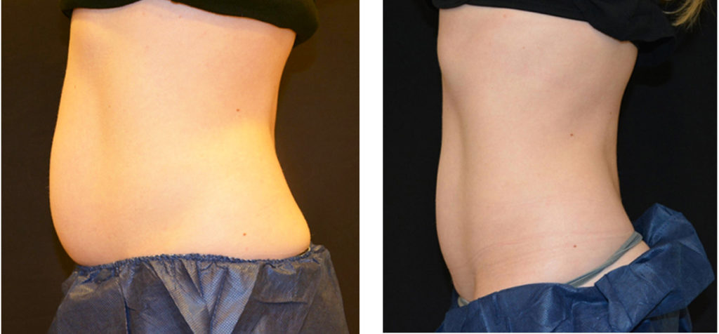 Coolsculpting Before And After - Shaping My Waist - Whistler Medical  Aesthetics