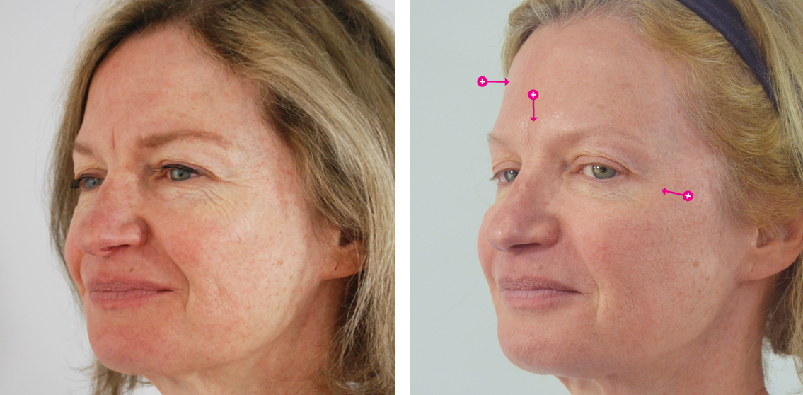 Botox Before and After