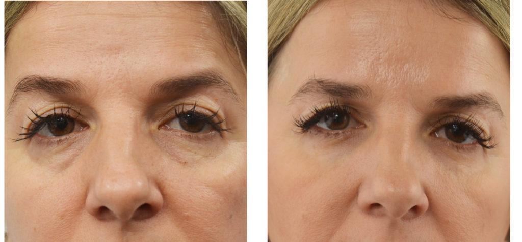 Bags Under Eyes Treatment Package