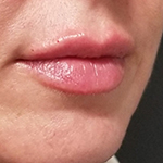 Lip Filler Before and After Photo
