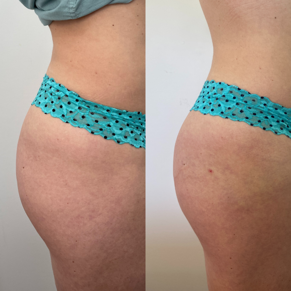 Yes, You Can Get a Non-Surgical Butt Lift with Injectables